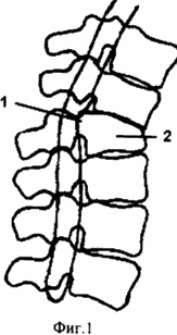 СПОСОБ ХИРУРГИЧЕСКОГО ЛЕЧЕНИЯ ПОСЛЕДСТВИЙ ПЕРЕЛОМОВ ПОЗВОНОЧНИКА